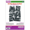 Broken Bones X-Ray Set of 15