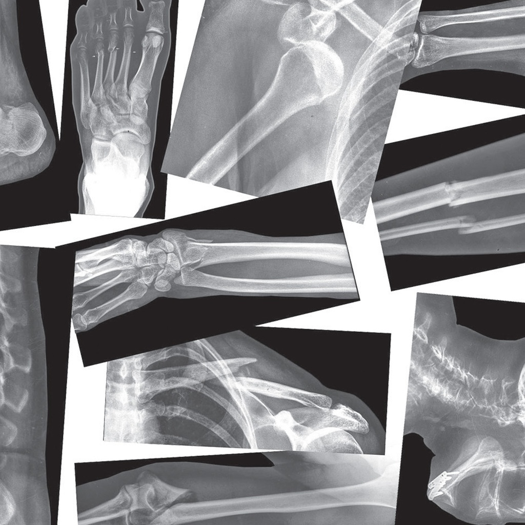 Broken Bones X-Ray Set of 15