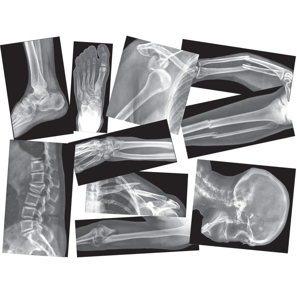 Broken Bones X-Ray Set of 15